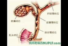 三个民间偏方治疗胆结石有奇效