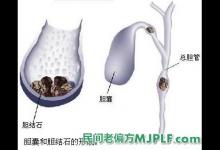 四个中药偏方治疗治慢性胆囊炎