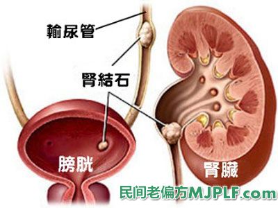 肾结石尿血