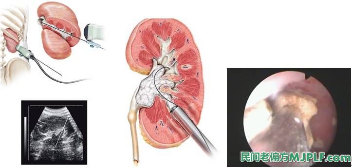肾结石偏方