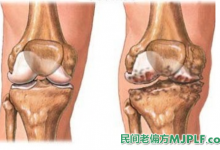 三个民间偏方治疗骨质增生有奇效